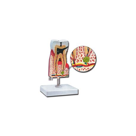 ALLTID SCIENTIFIC MODEL ANATÓMICO MOLAR INFERIOR WITH CARIES