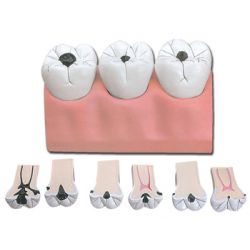 HOCHY WISSENSCHAFTLICH MODELLINO ANATOMICO CARIE DENTALE