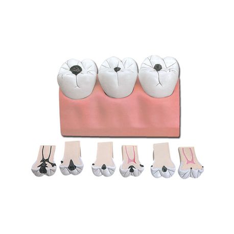ALTAY SCIENTIFIC MODELLINO ANATOMICO CARIE DENTALE