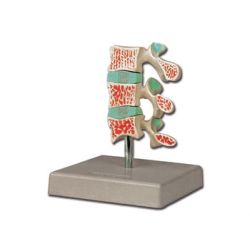 HIGHY MODEL OF ADVANCED OSTEOPOROSIS PATHOLOGY