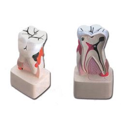 HIGH AND SCIENTIFIC ANATOMICAL MODEL DENTAL PATHOGIA